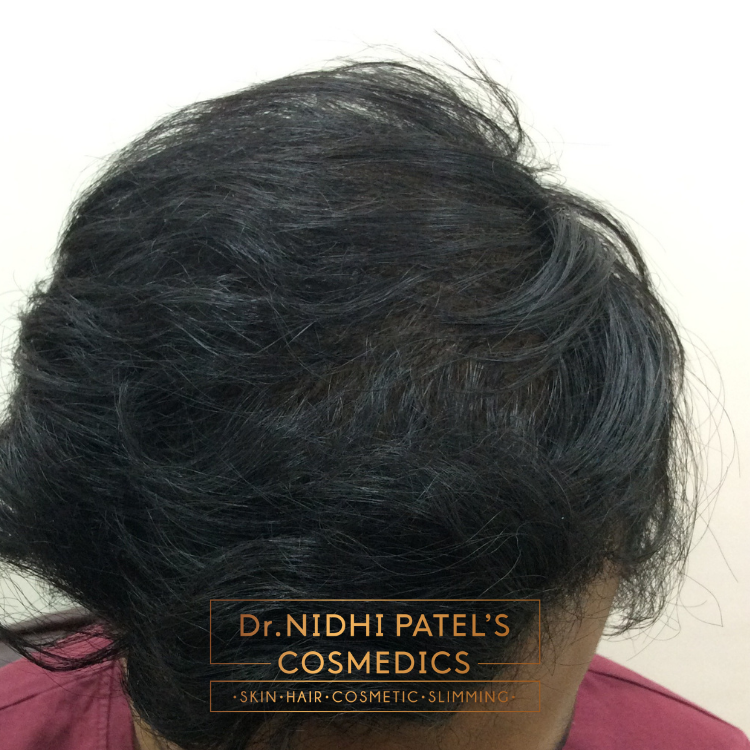 Hair Loss Treatment in Vadodara | Best Dermatologist for Hair Loss in Vadodara