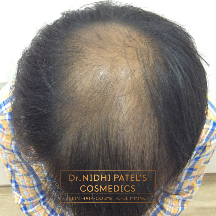 Hair Loss Treatment in Vadodara | Best Dermatologist for Hair Loss in Vadodara