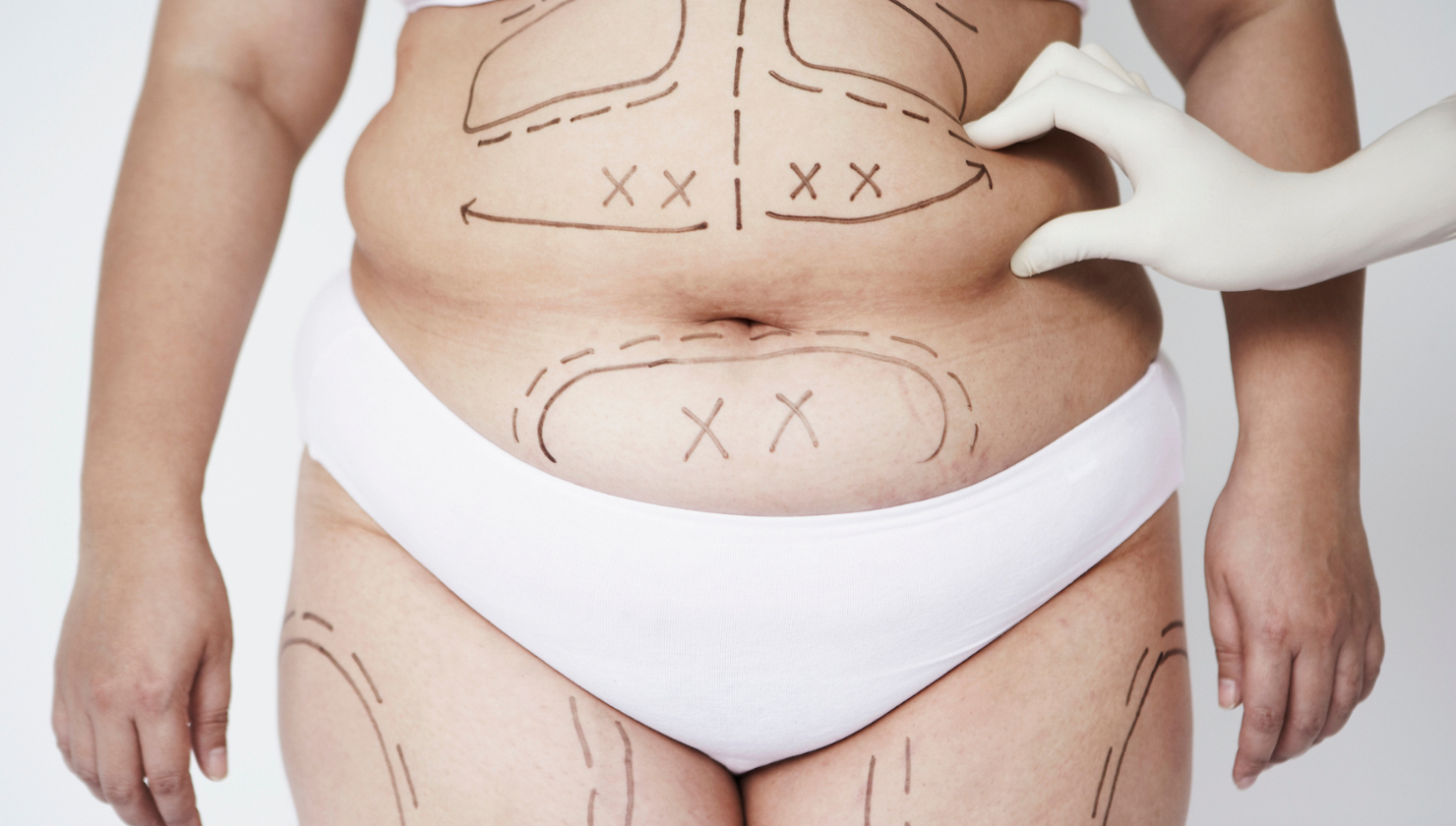 Liposuction - What It Is, Surgery, Recovery & Results