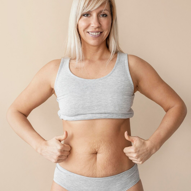 Stretch Marks Removal Treatment in Vadodara | Best Stretch Marks Treatment Clinic in Vadodara