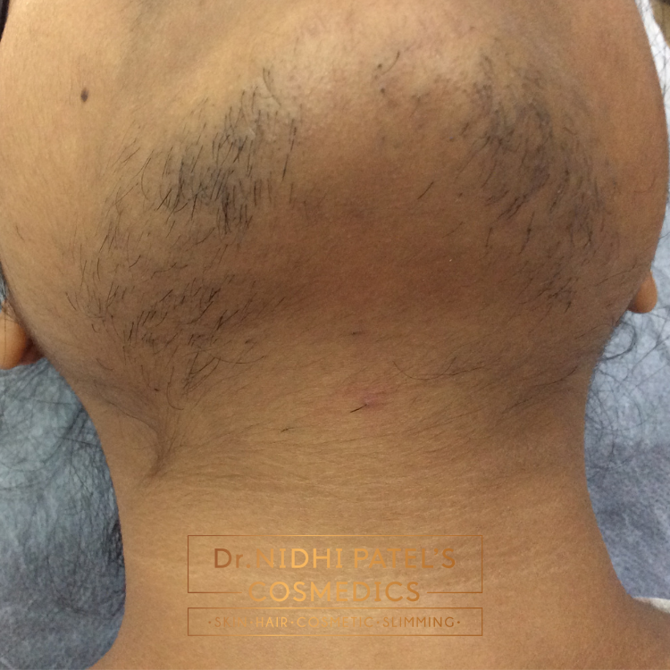 Laser Hair Removal Treatment in Vadodara | Best Laser Hair Removal Treatment Clinic in Vadodara