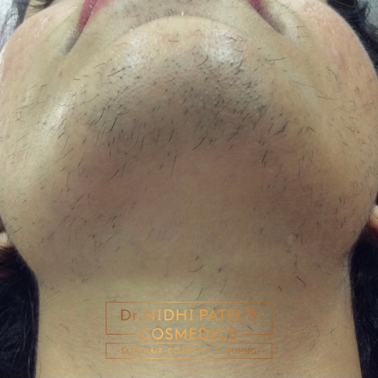 Laser Hair Removal Treatment in Vadodara | Best Laser Hair Removal Treatment Clinic in Vadodara