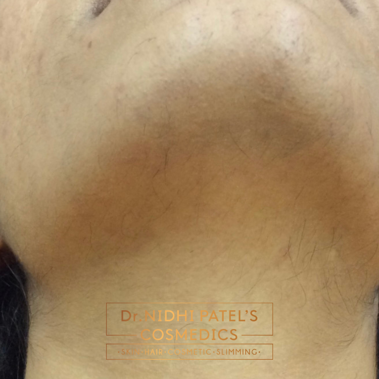 Laser Hair Removal Treatment in Vadodara | Best Laser Hair Removal Treatment Clinic in Vadodara