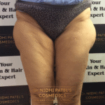 Dermal Fillers Treatment in Vadodara | Best Dermal Fillers Clinic in Vadodara