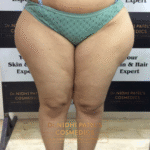 Dermal Fillers Treatment in Vadodara | Best Dermal Fillers Clinic in Vadodara