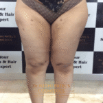 Dermal Fillers Treatment in Vadodara | Best Dermal Fillers Clinic in Vadodara