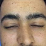 Best Q Switch Laser Toning Treatment in Vadodara | Laser Toning Treatment Clinic in Vadodara