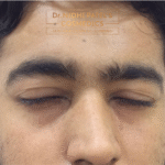 Best Q Switch Laser Toning Treatment in Vadodara | Laser Toning Treatment Clinic in Vadodara