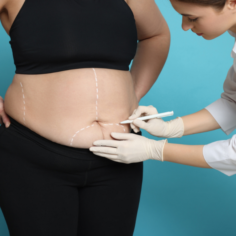 Liposuction Surgery in Vadodara | Liposuction Surgery in Vadodara
