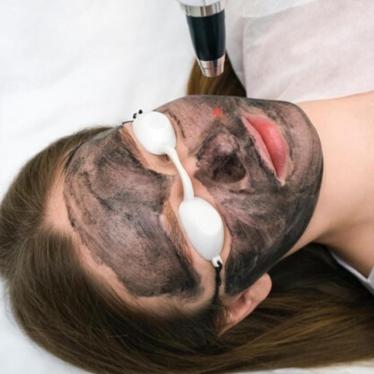 Best Carbon Laser Facial Treatment in Vadodara | Carbon Laser Treatment Clinic in Vadodara