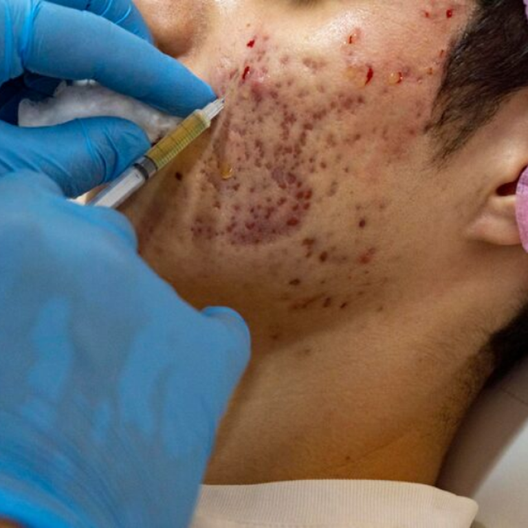 Chemical Peeling Treatment in Vadodara | Best Chemical Peeling Clinic in Vadodara for Skin Rejuvenation