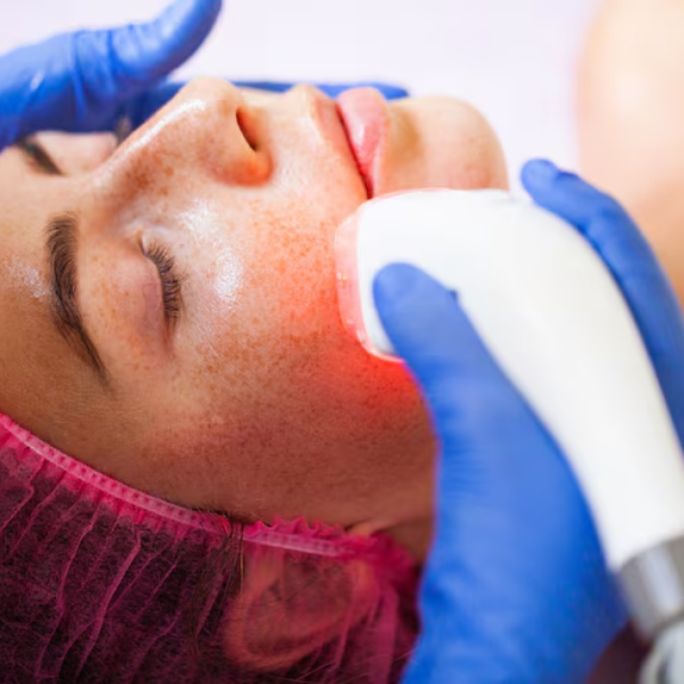 Best CO₂ Fractional Laser Treatment in Vadodara | CO₂ Laser Treatment Clinic in Vadodara