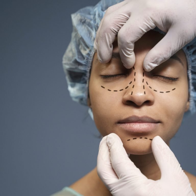 Rhinoplasty