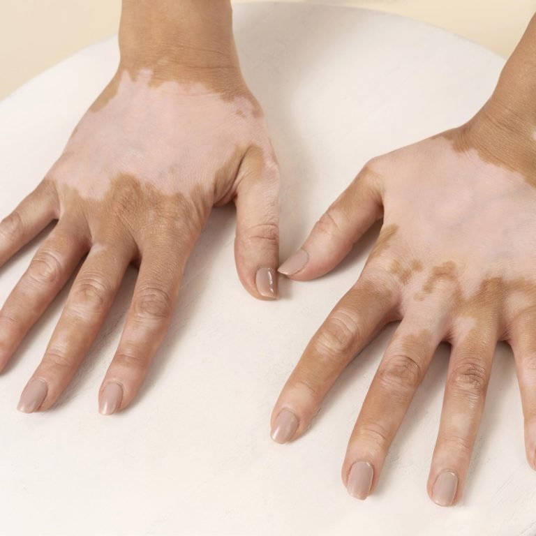 Vitiligo Surgery