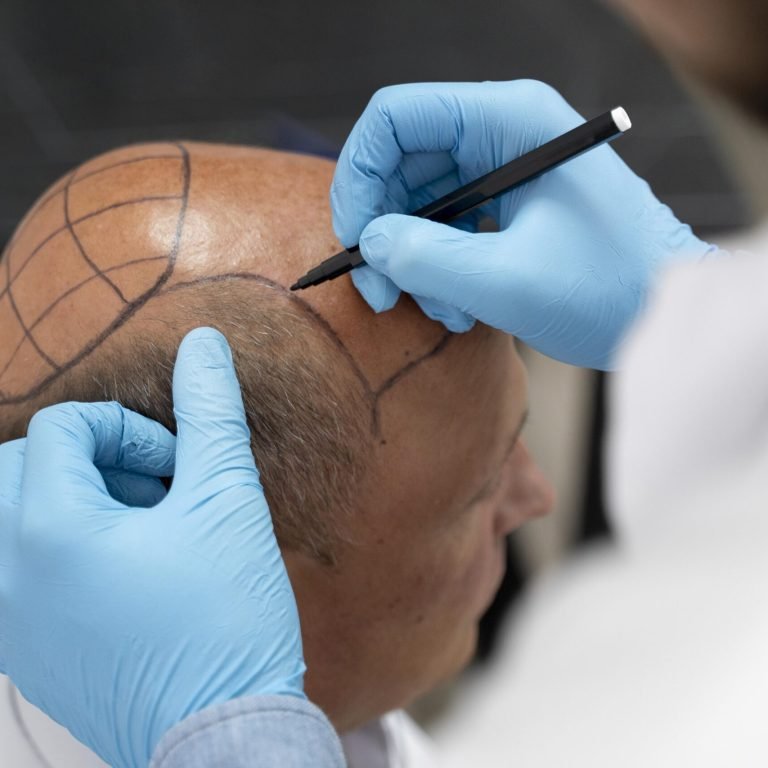 Hair Loss Treatment in Vadodara | Best Dermatologist for Hair Loss in Vadodara